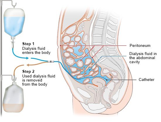 Illustration: In peritoneal dialysis, dialysis fluid is passed into the abdominal cavity – as described in the information