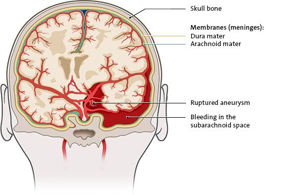 The illustration shows a subarachnoid hemorrhage, where blood flows into the fluid-filled space surrounding the brain.