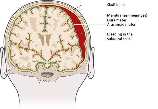 The illustration shows a subdural hemorrhage, with bleeding into the narrow spaces between the two membranes covering the brain (meninges).
