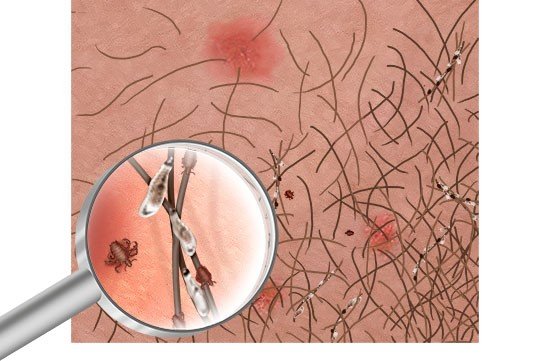 Illustration: What pubic lice bites look like