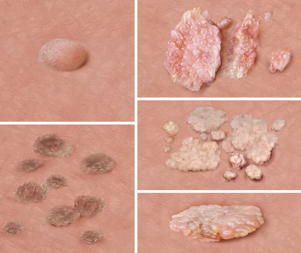 Illustration: Examples of genital warts