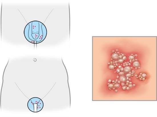 Illustration: Where genital herpes occurs and what it looks like