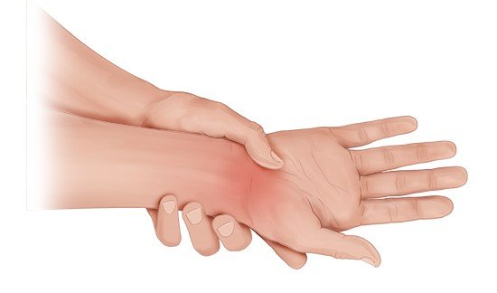 Illustration: Sprained wrist