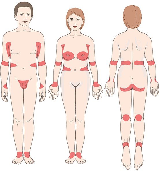Illustration: Skin areas commonly affected by scabies