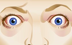 Illustration: Bulging eyes in a person with Graves’ disease