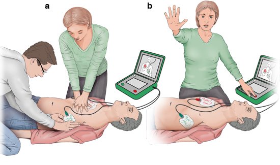 Illustration: Using a defibrillator: a) Placing electrodes on chest and doing chest compressions, b) Pressing the shock button, making sure not to touch the unconscious person