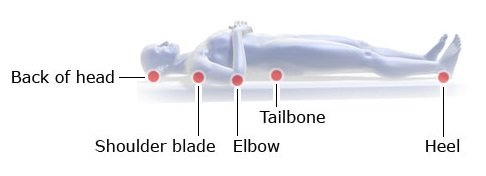 Illustration: Pressure ulcers: Places where they commonly develop while lying on your sideIllustration: Pressure ulcers: Places where they commonly develop while lying on your back