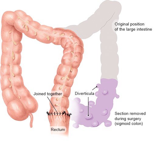 Illustration: Sigmoid resection: the most common type of surgery for diverticular disease – as described in the article