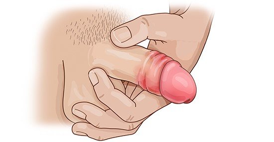 Illustration: Balanitis in an adult man with foreskin pulled back