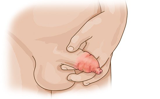 Illustration: Balanitis in a child with a tight foreskin
