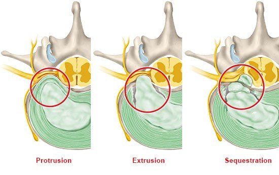 Illustration: Types of slipped discs: Protrusion, extrusion and sequestration (cross-sectional view of the lumbar spine – from above)