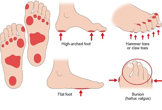 Illustration: Areas that are particularly prone to diabetic foot ulcers