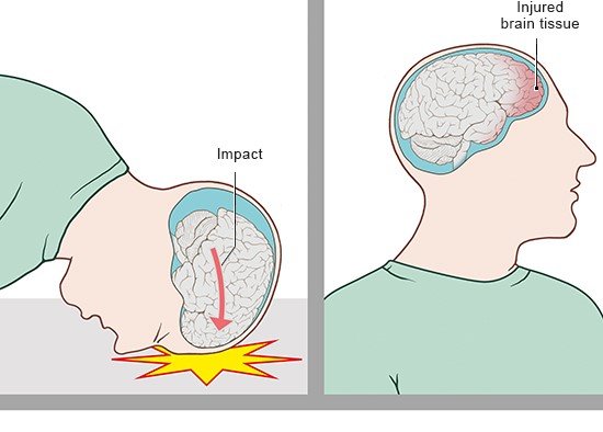 Image: Concussion: Impact of a strike to the head
