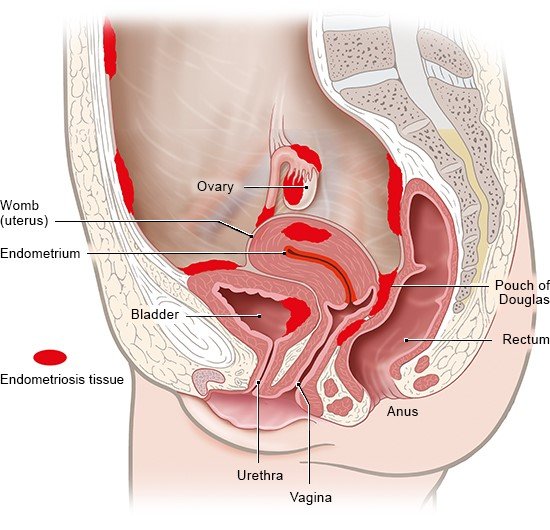 Illustration: Endometrial implants in the abdomen – as described in the article