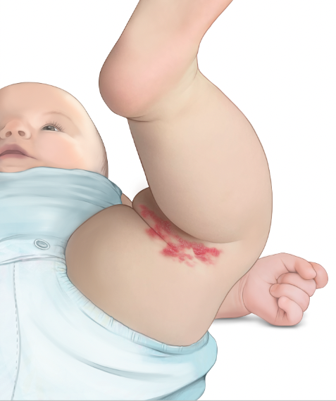 Illustration: Baby with hemangioma on their thigh