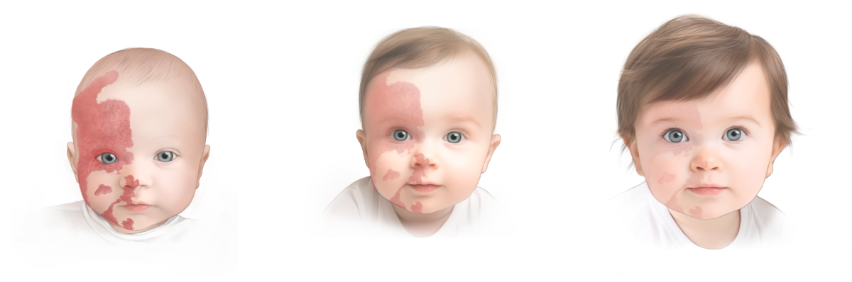Illustration: Example of a hemangioma going away during treatment