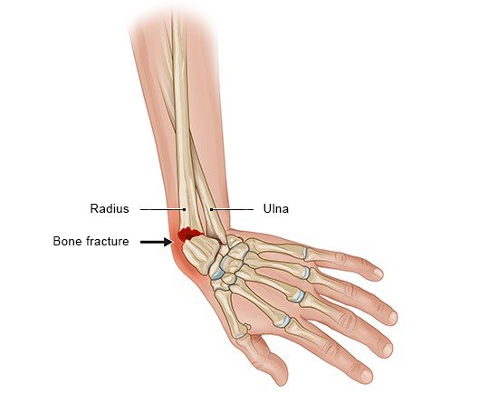 Illustration: Wrist fracture
