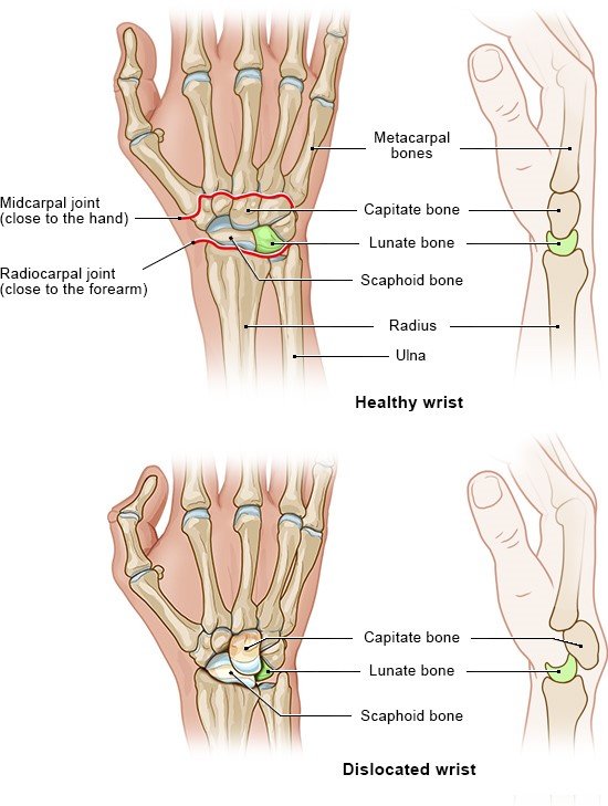 Illustration: Healthy wrist and dislocated wrist