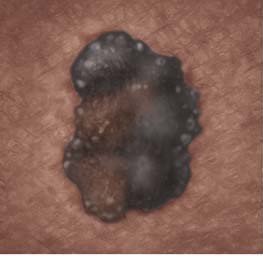 Illustration: Non-melanoma skin cancer might look like this on dark skin