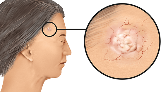 Illustration: Non-melanoma skin cancer might look like this on the temples (light skin) 