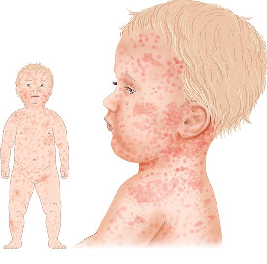 Illustration: Typical rash in a child who has measles