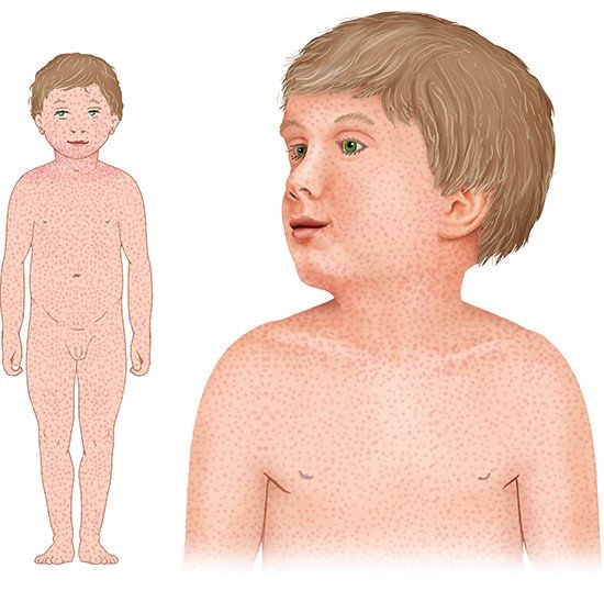 Illustration: Typical rash in rubella