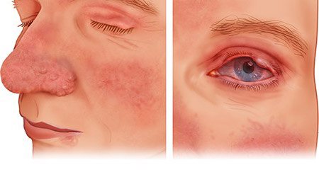 Illustration: Type 3 and type 4 rosacea – as described in the article