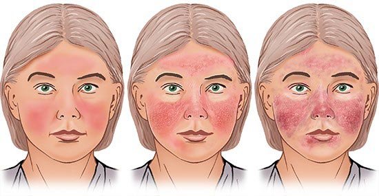 Illustration: Type 1 and type 2 rosacea (varying degrees of severity) – as described in the article