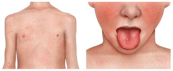 Illustration: Scarlet fever: Rash and “strawberry tongue” – as described above