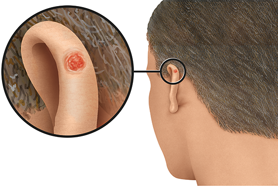 Illustration: Non-melanoma skin cancer might look like this on the ear (light skin)