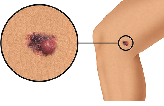 Illustration: Melanoma skin cancer on the knee (light skin)
