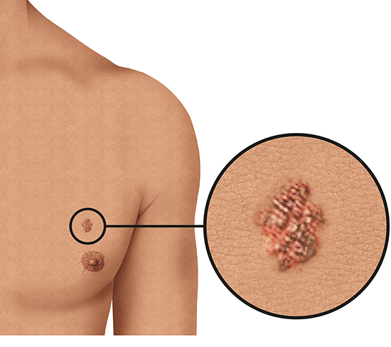 Illustration: Melanoma skin cancer on the chest (light skin)