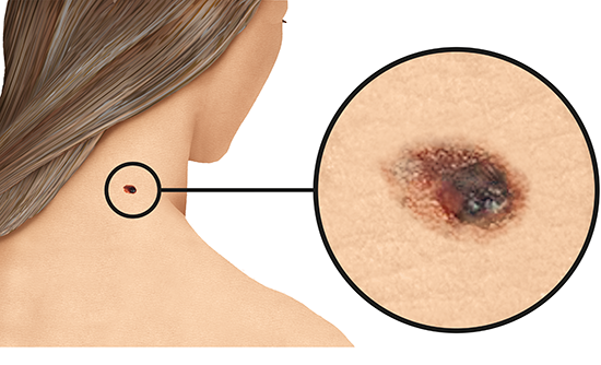 Illustration: Melanoma skin cancer on the neck (light skin)