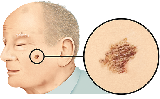 Illustration: Melanoma skin cancer on the cheek (light skin)