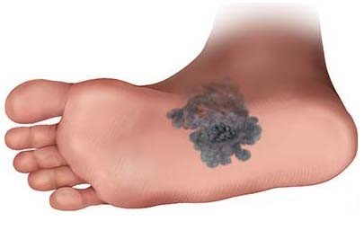 Illustration: Melanoma skin cancer under the foot (dark skin)