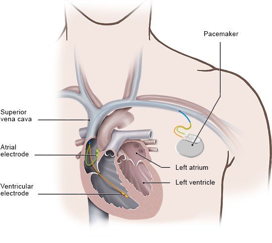 Illustration: Pacemaker with electrodes in the right side of the heart - as described in the information