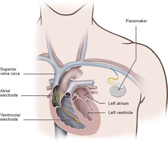 Illustration: Pacemaker with leads on the right side of the heart