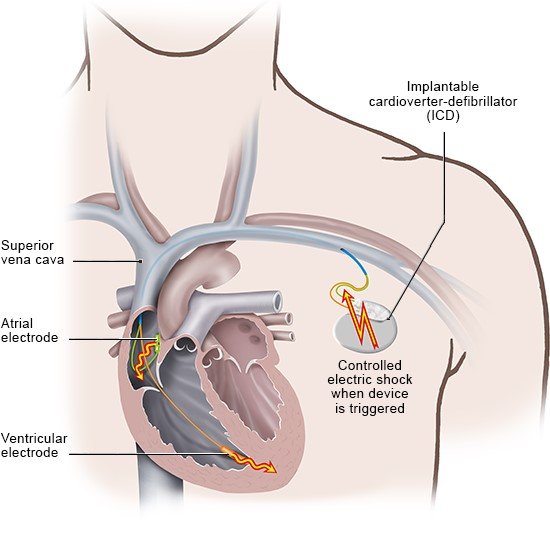 Illustration: An ICD delivers one or several brief, controlled electric shocks to return the person’s heartbeat to normal