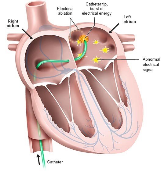 Illustration: Parts of the left atrium are destroyed (ablated) using a catheter.