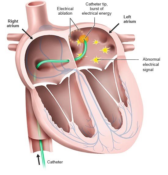 Illustration: A catheter is used to destroy the areas that are causing heart rhythm disorders