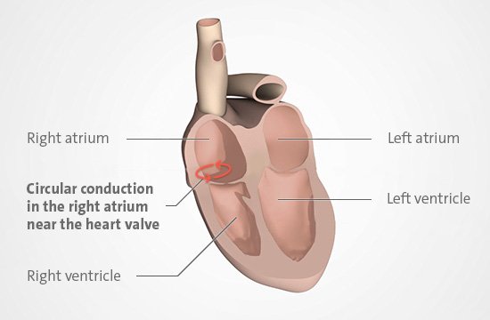 Illustration: Atrial flutter typically develops in the right atrium.