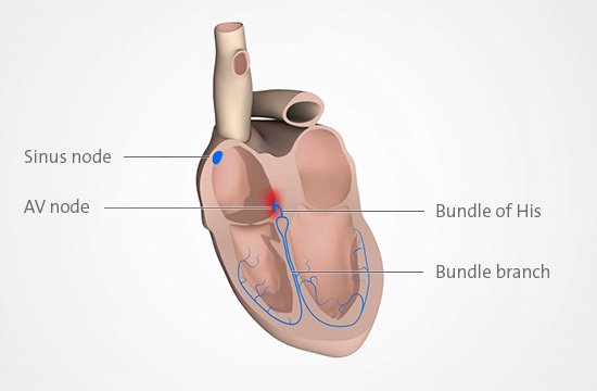 Illustration: In AV block, electrical signals in the heart are disrupted