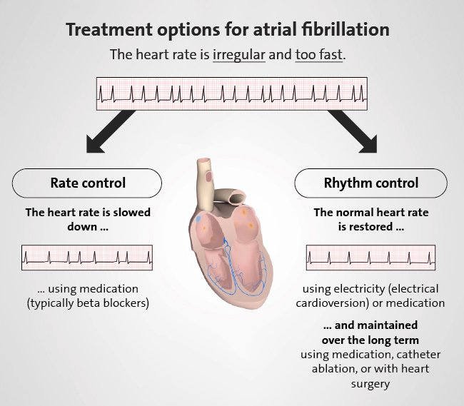 Illustration: Ways of influencing the heart rhythm to treat atrial fibrillation