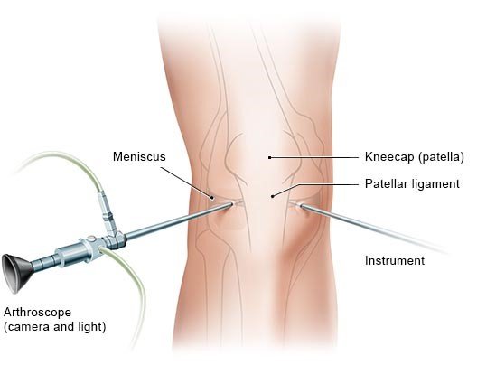 Illustration: Knee arthroscopy