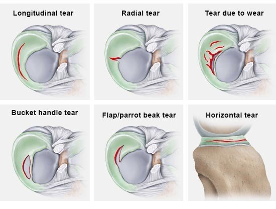 Figure: Different types of meniscus tears (cross sections viewed from the top – except for the bottom right image: view from the side)