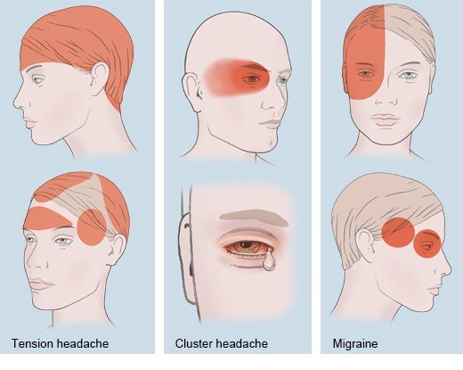 Illustration: Common types of headaches: Where they typically occur – as described in the article