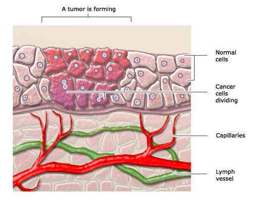 Illustration: Carcinoma in situ