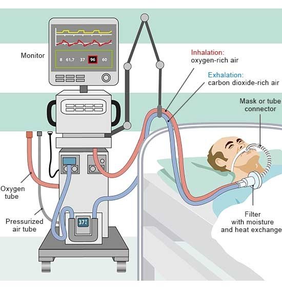 How does mechanical ventilation work during an operation?