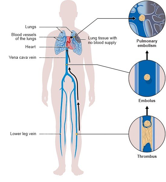 Illustration: How thrombosis leads to pulmonary embolism