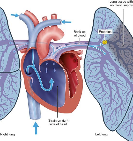 Illustration: Heart strain due to pulmonary embolism